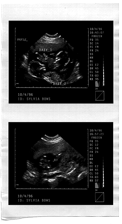 Two Sylvia Bows Ultrasound Images