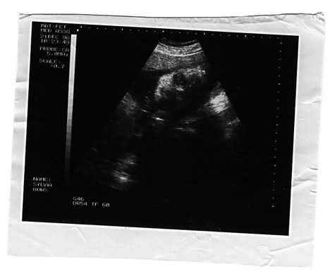 Two Sylvia Bows Ultrasound Images